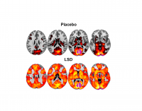 LSD-Brain-Imaging-Study-2