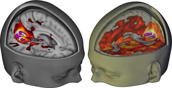 Increase in the brain connectivity after LSD (right), compared to placebo (left)